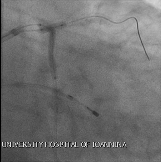 Image2 kissing balloon dilation